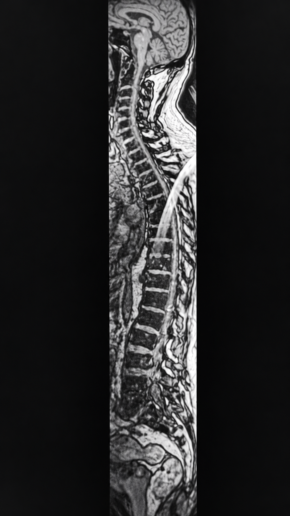 MRI scan from Alan Bates' diagnosis